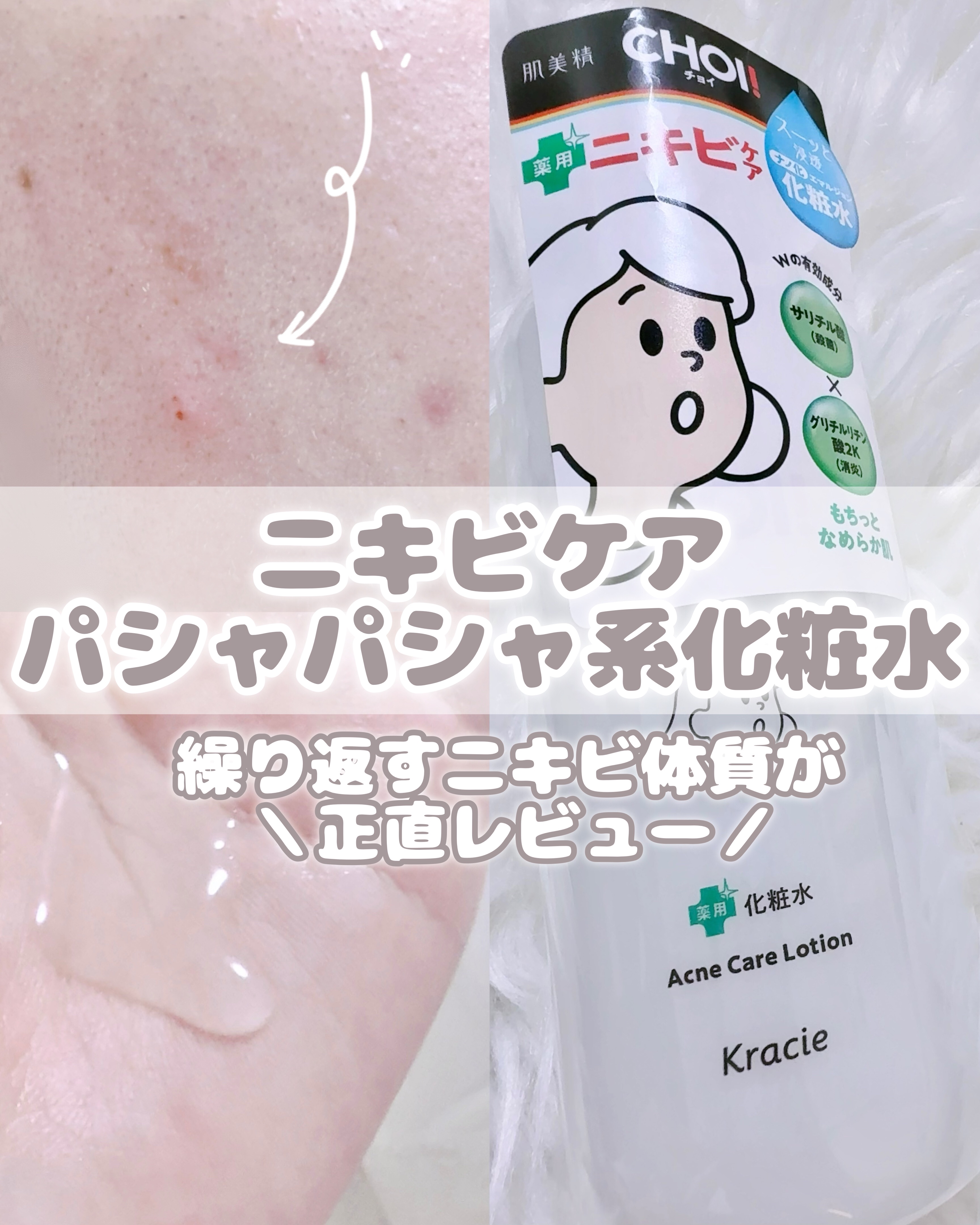 肌美精 CHOI薬用化粧水 ニキビケア[医薬部外品]/肌美精/化粧水を使ったクチコミ（1枚目）