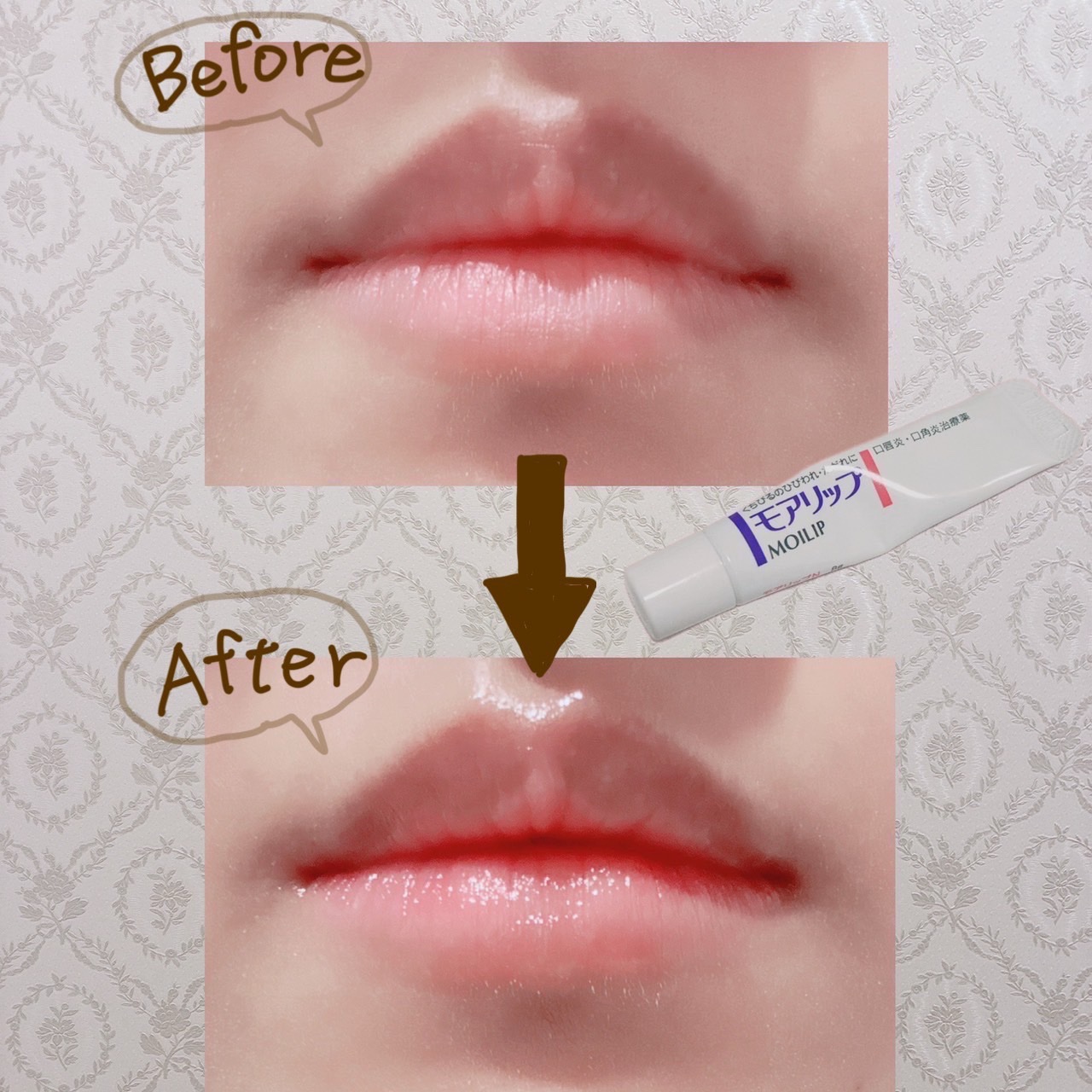 モアリップ N (医薬品)/資生堂薬品/その他を使ったクチコミ（3枚目）