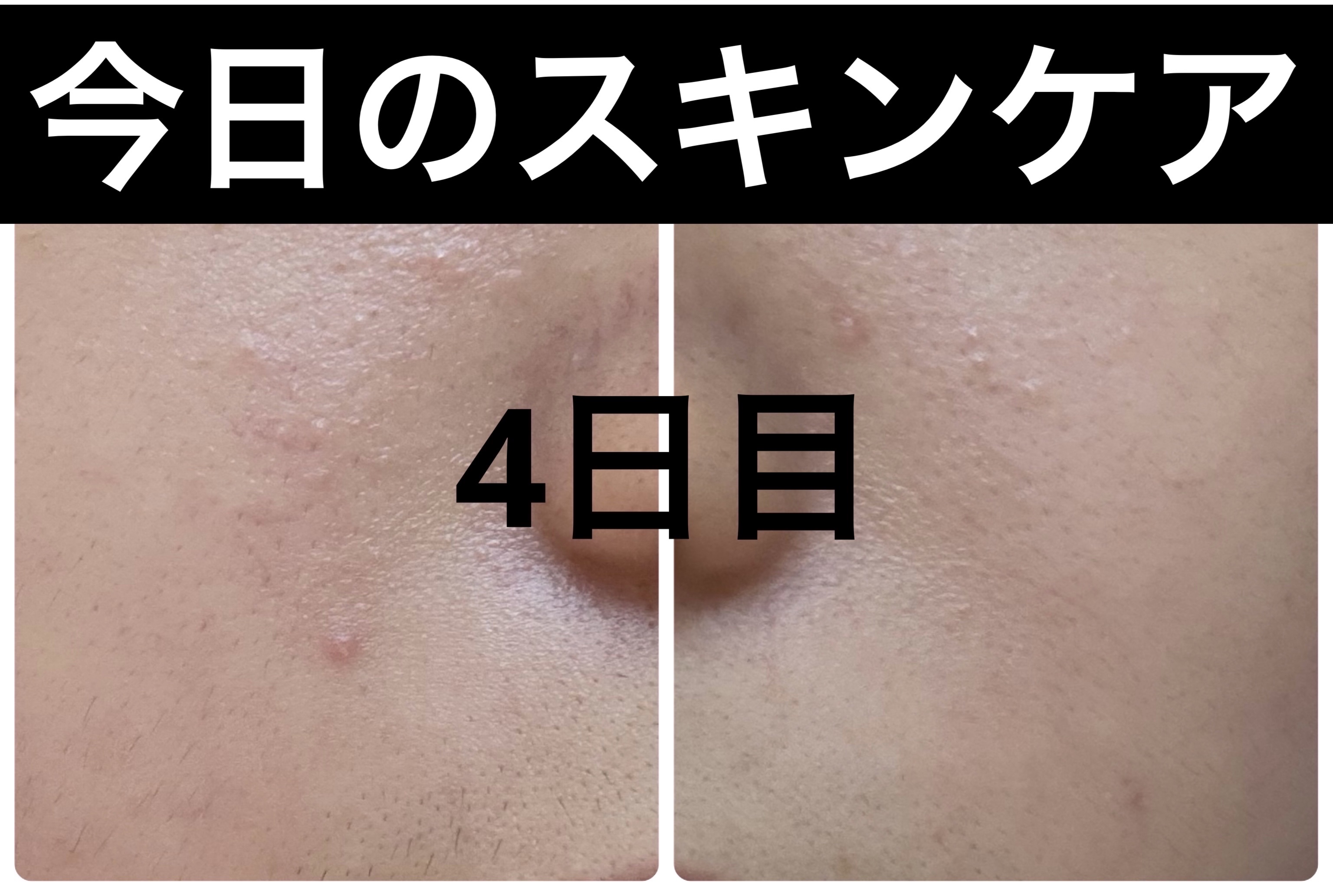 Hadaral 十味敗毒湯錠(医薬品)/大峰堂/その他を使ったクチコミ（1枚目）