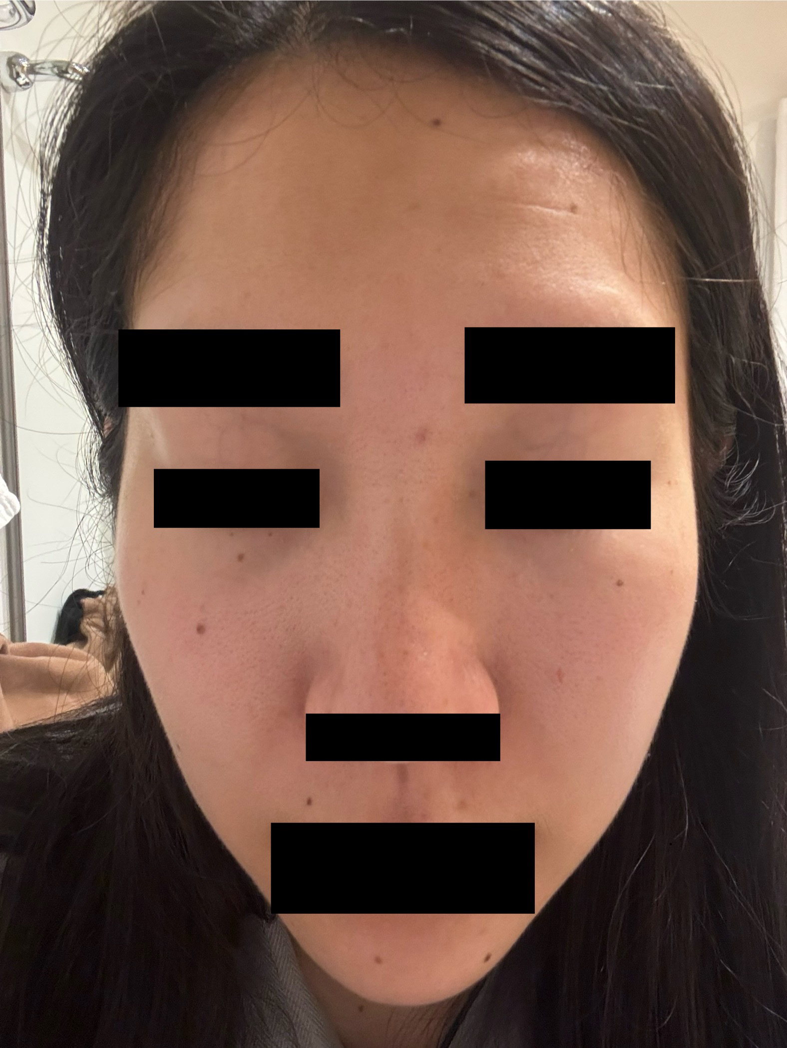 オバジX リフトローション/オバジ/化粧水を使ったクチコミ（1枚目）