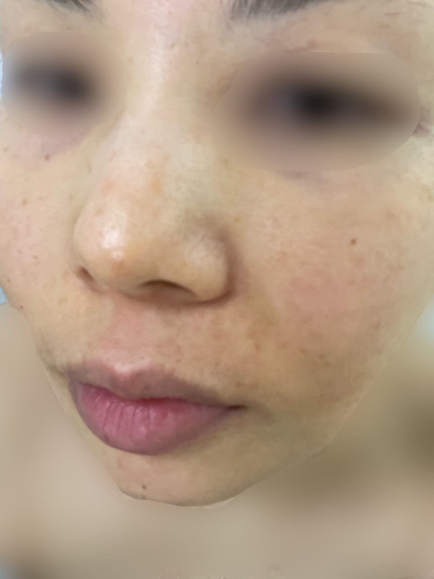 ãã£ãŒããªãŒããŒãããŒãªã³ã°ããã¯/WellDerma/æŽãæµãããã¯ã»ãã¹ã¯ã䜿ã£ãã¯ãã³ãïŒ2æç®ïŒ