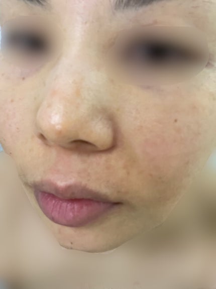 ティーツリーハーブピーリングパック/WellDerma/洗い流すパック・マスクを使ったクチコミ(2枚目)