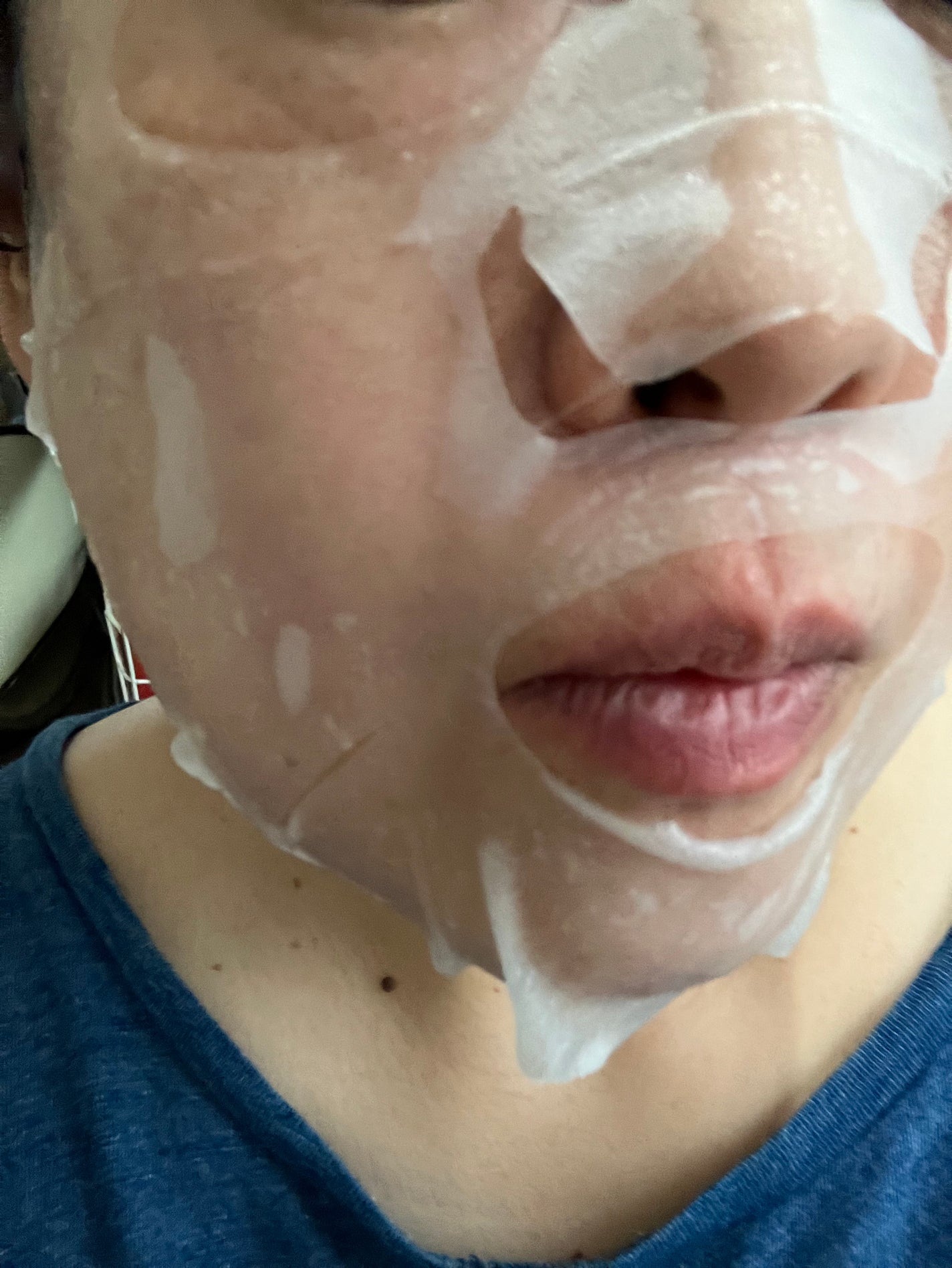 メディリフト ニードルリフトシートマスク/YA-MAN TOKYO JAPAN/シートマスク・パックを使ったクチコミ(4枚目)