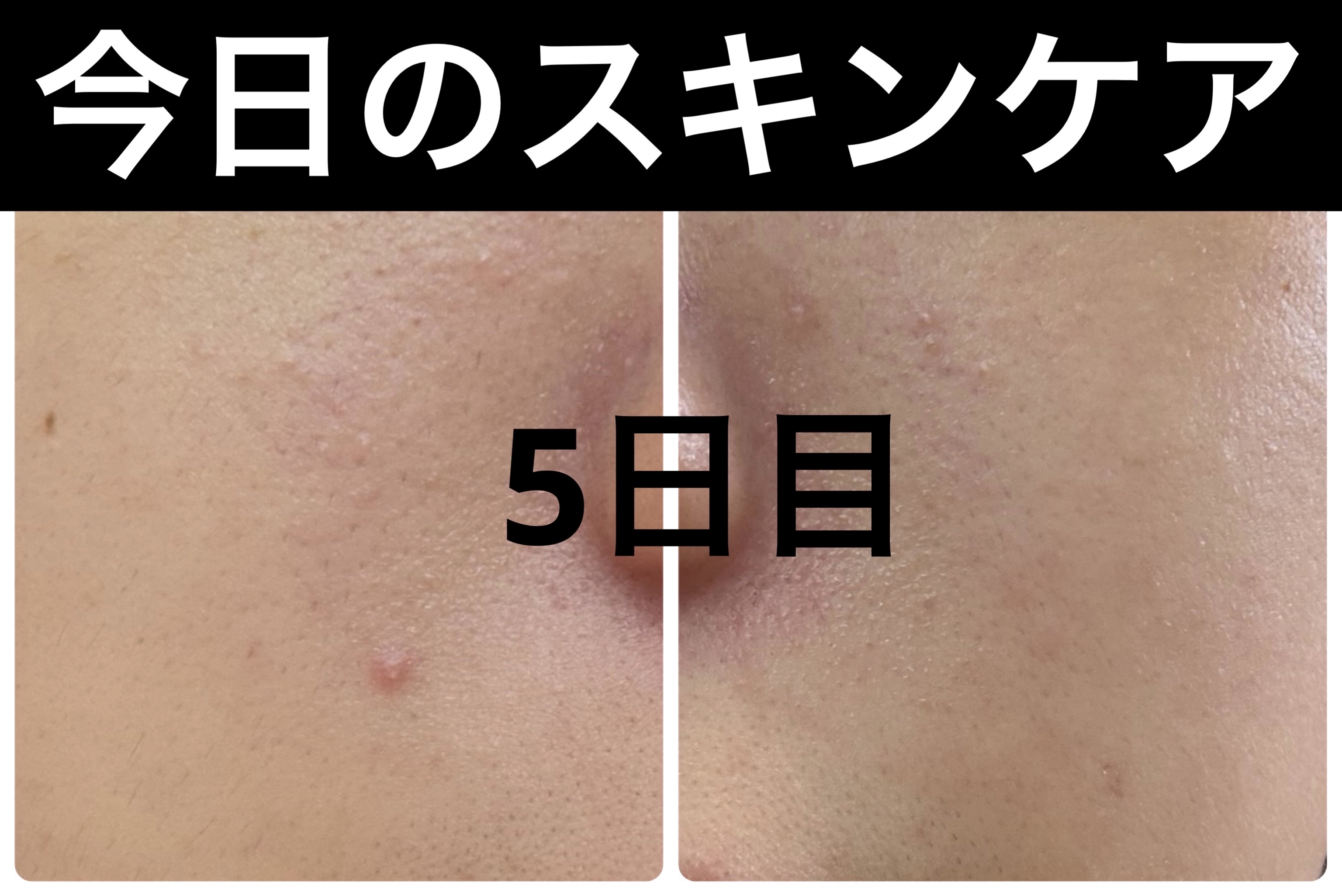 Hadaral 十味敗毒湯錠(医薬品)/大峰堂/その他を使ったクチコミ（1枚目）