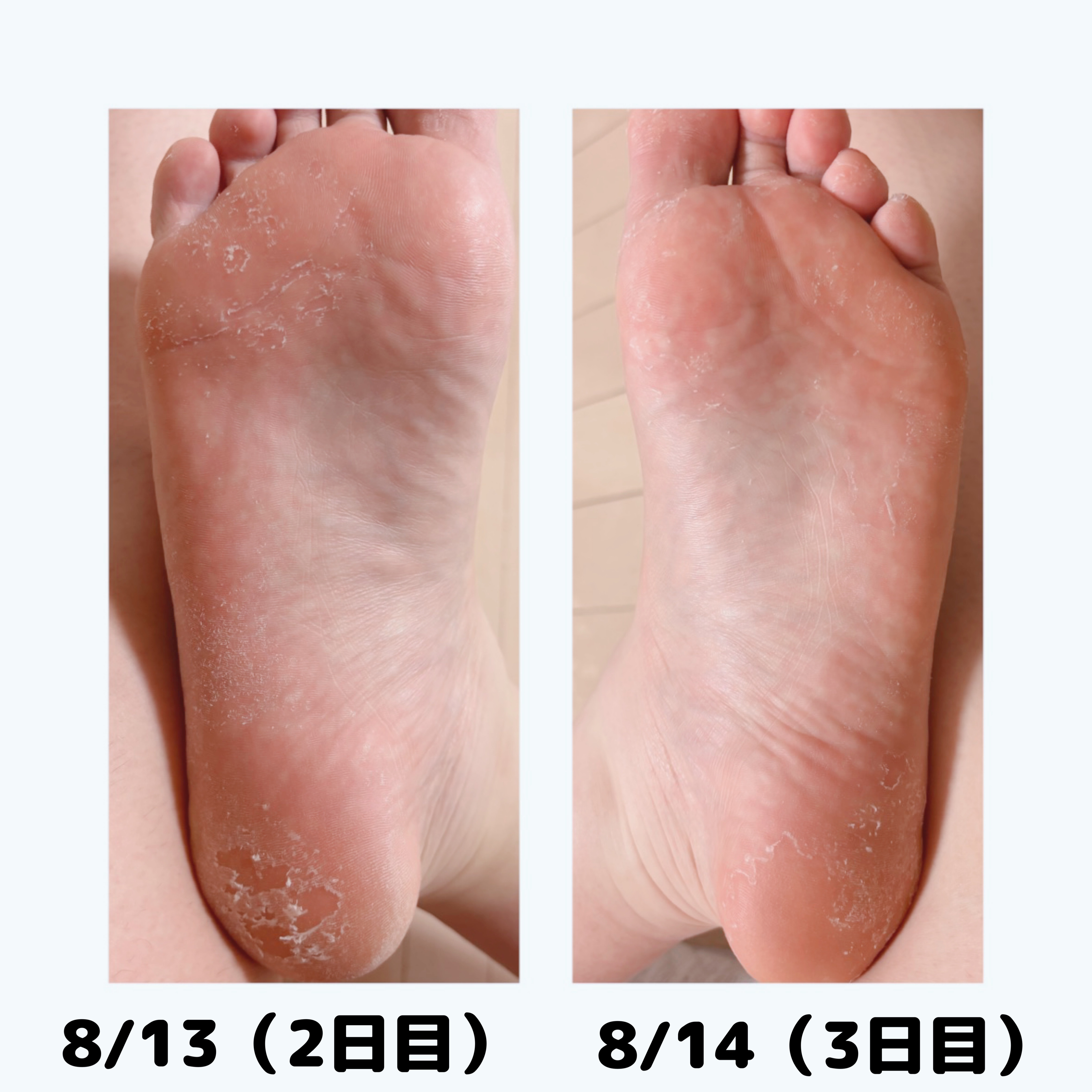 Annyo フットパック カウ柄 ヴァーベナの香り/ピエラス/レッグ・フットケアを使ったクチコミ（3枚目）