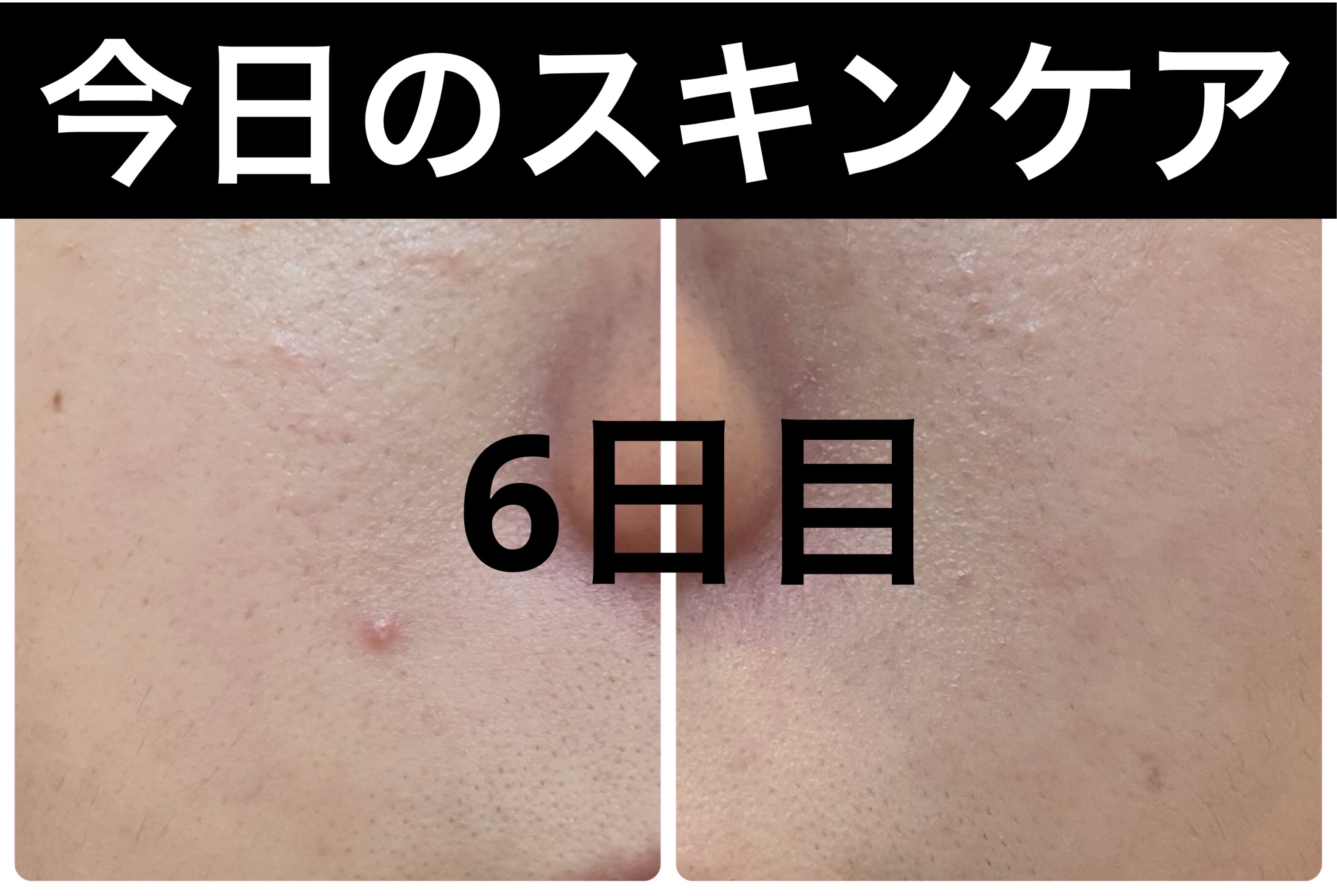 Hadaral 十味敗毒湯錠(医薬品)/大峰堂/その他を使ったクチコミ（1枚目）