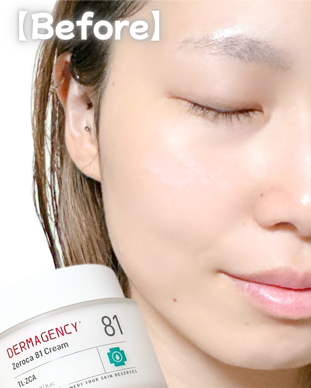 ダーマジェンシー ゼロカ81 クリーム/DERMAGENCY/フェイスクリームを使ったクチコミ（3枚目）