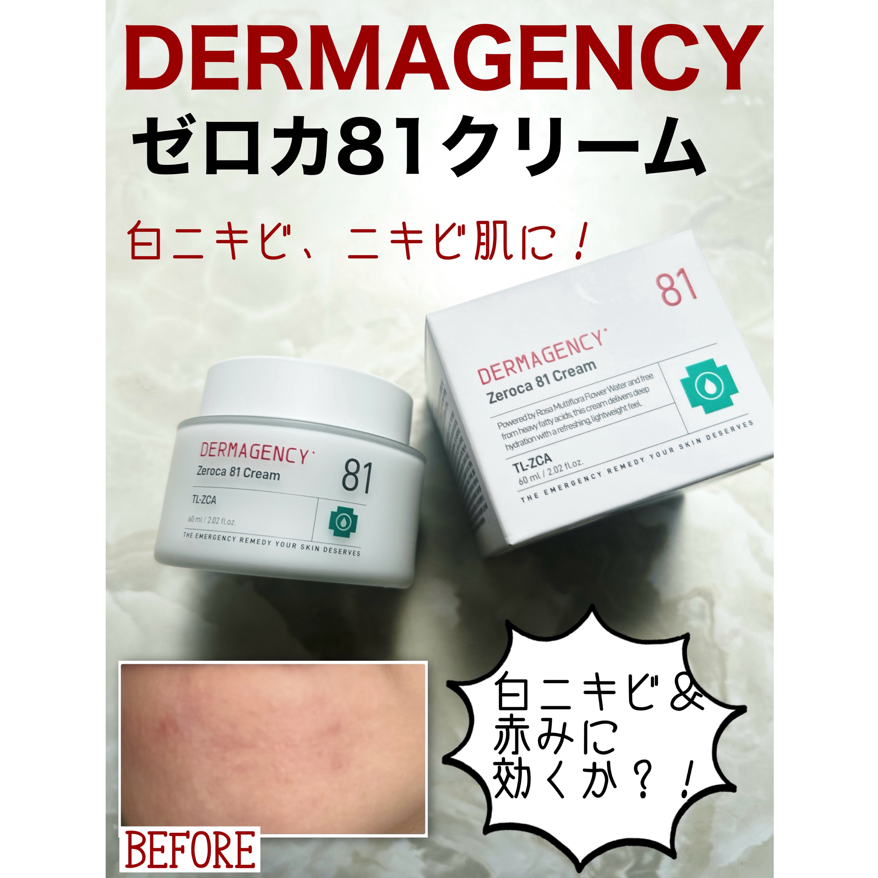 ダーマジェンシー ゼロカ81 クリーム/DERMAGENCY/フェイスクリームを使ったクチコミ（1枚目）