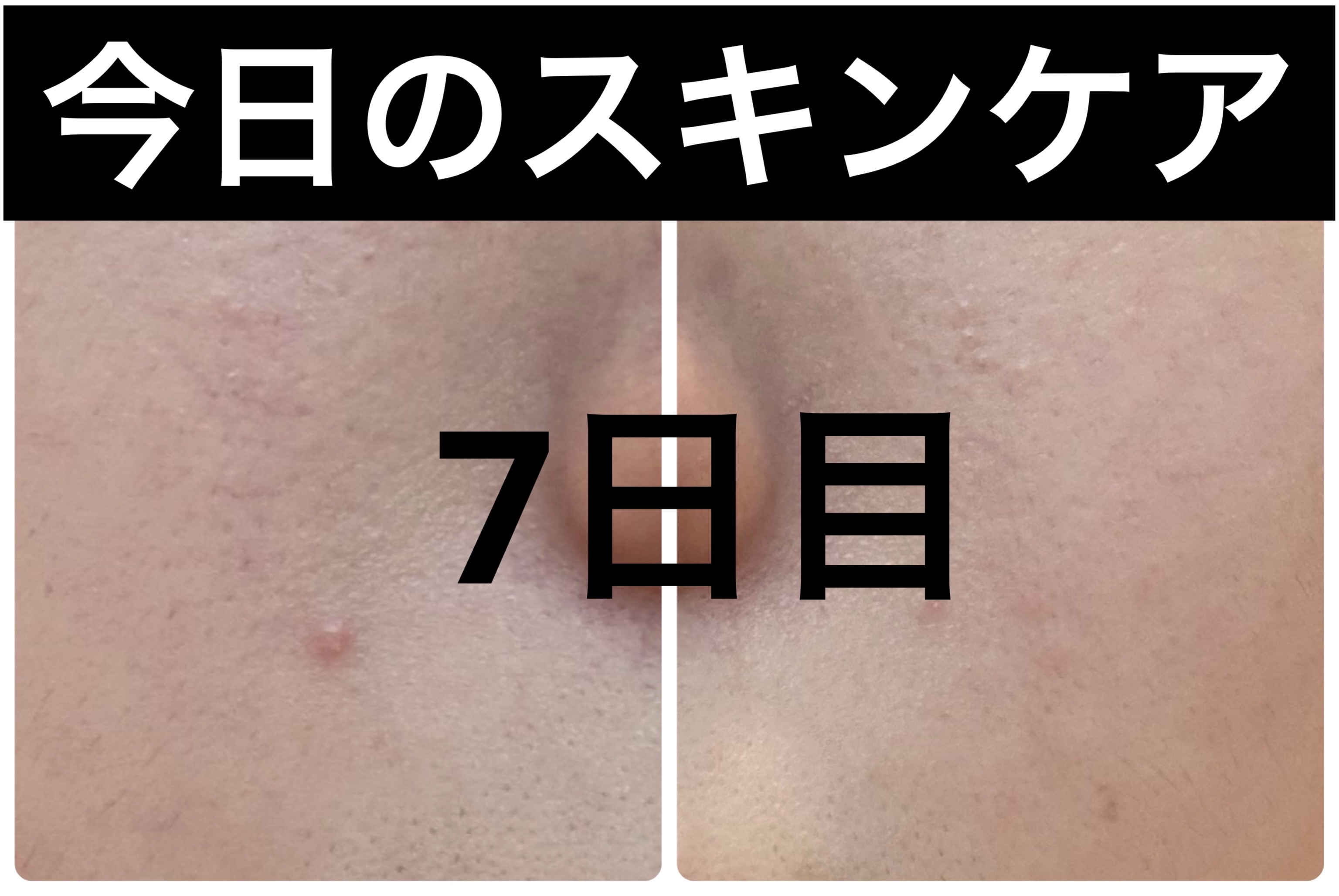 Hadaral 十味敗毒湯錠(医薬品)/大峰堂/その他を使ったクチコミ（1枚目）