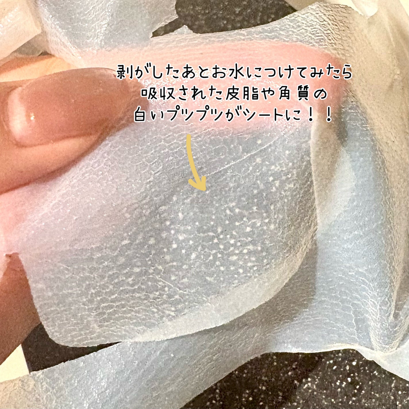 トラブルパッチマスク/EIOM/その他スキンケアを使ったクチコミ(2枚目)