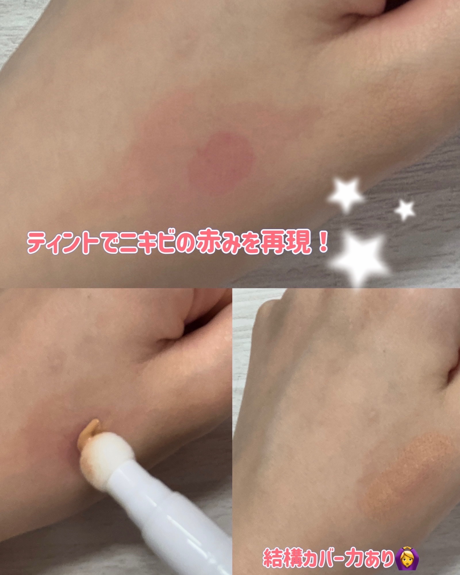 薬用アクネコンシーラー/ONEPEN/スティックコンシーラーを使ったクチコミ（3枚目）