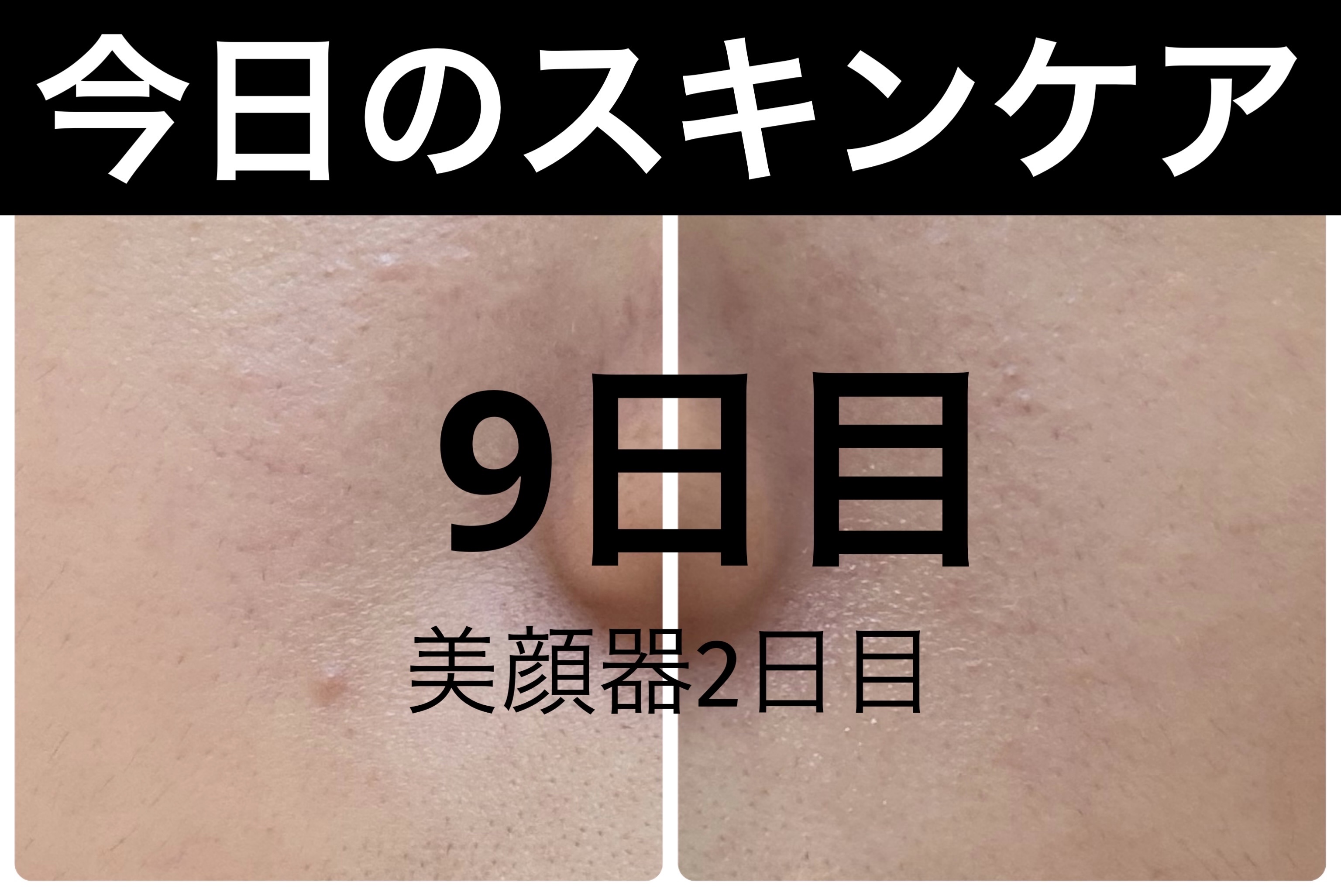 AGE-R ブースタープロ/MEDICUBE/美顔器・マッサージを使ったクチコミ（1枚目）