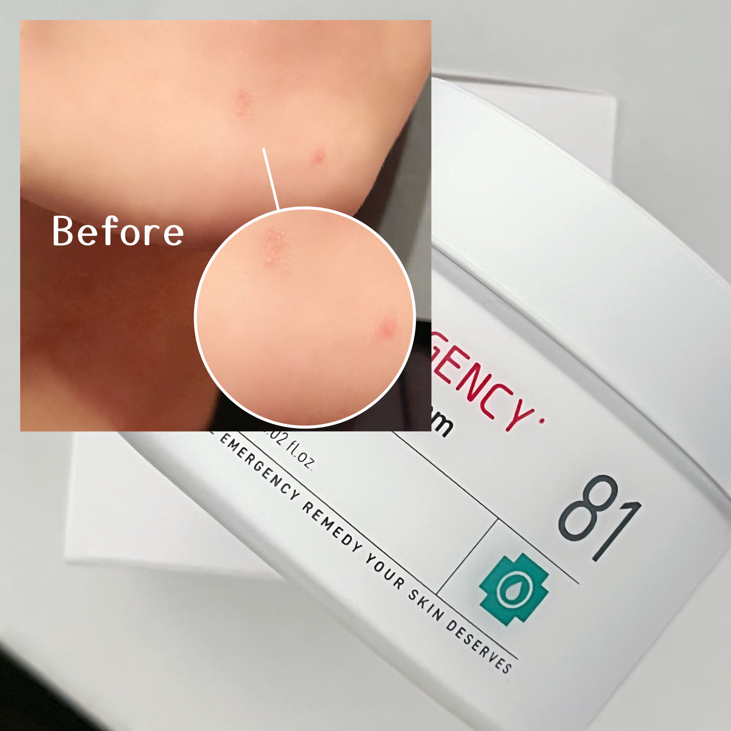 ダーマジェンシー ゼロカ81 クリーム/DERMAGENCY/フェイスクリームを使ったクチコミ（3枚目）