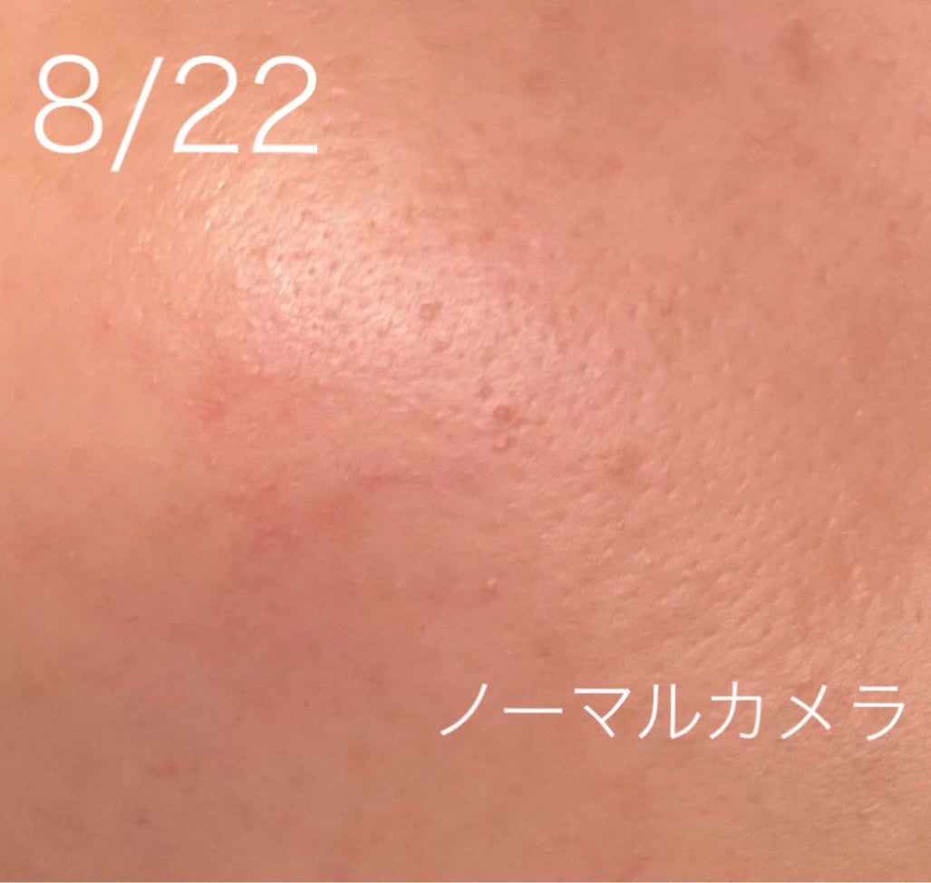ダーマジェンシー ゼロカ81 セラム/DERMAGENCY/美容液を使ったクチコミ(4枚目)