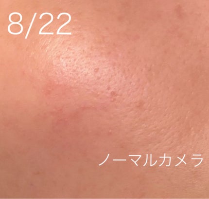 ダーマジェンシー ゼロカ81 セラム/DERMAGENCY/美容液を使ったクチコミ(4枚目)