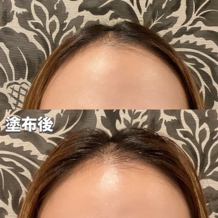 スカルプD ボーテ メディカルエストロジー スカルプセラム/アンファー(スカルプD)/頭皮ローションを使ったクチコミ(5枚目)