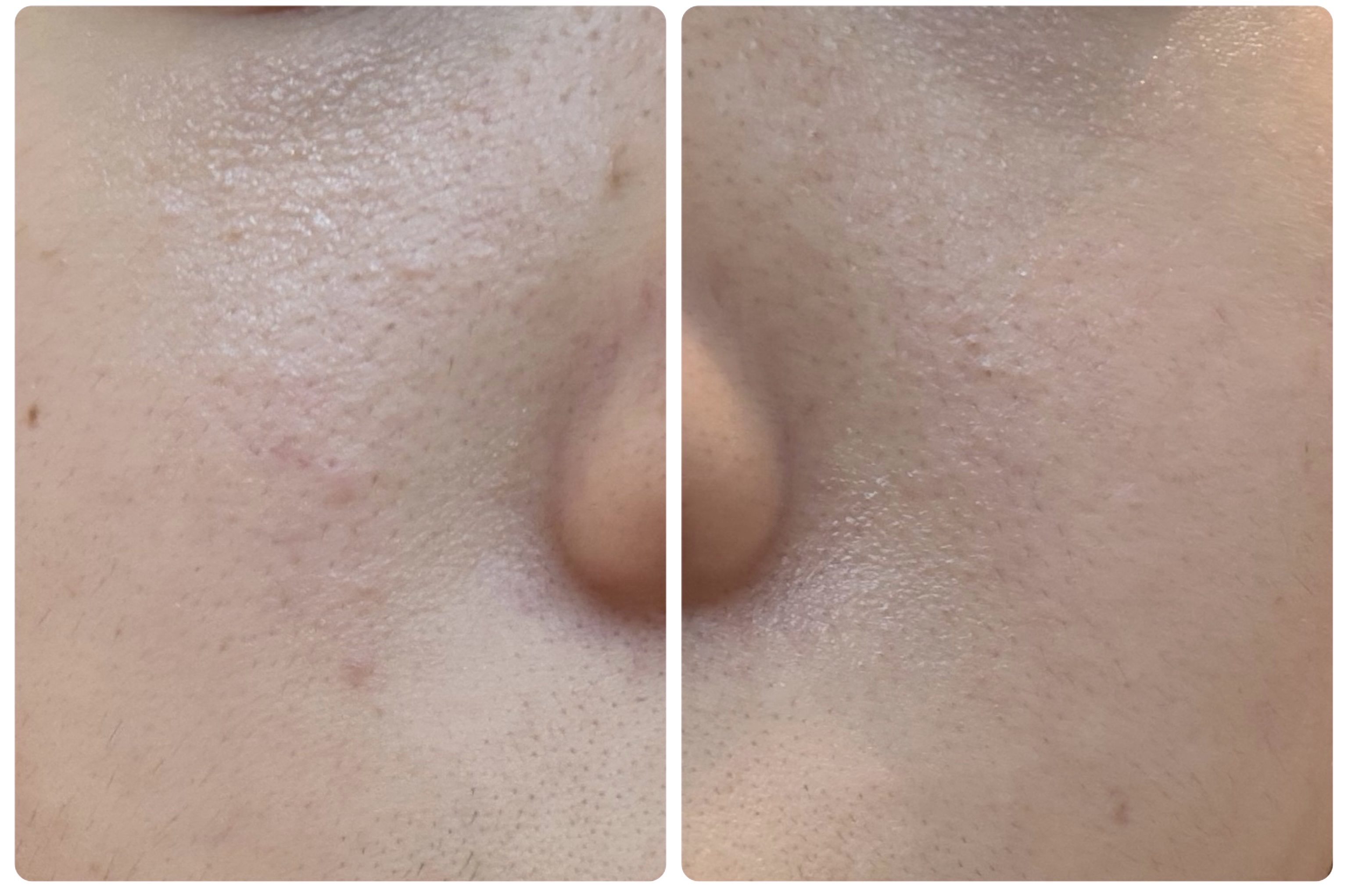 ディープブーストセラム/ブルーミオ/美容液を使ったクチコミ（3枚目）