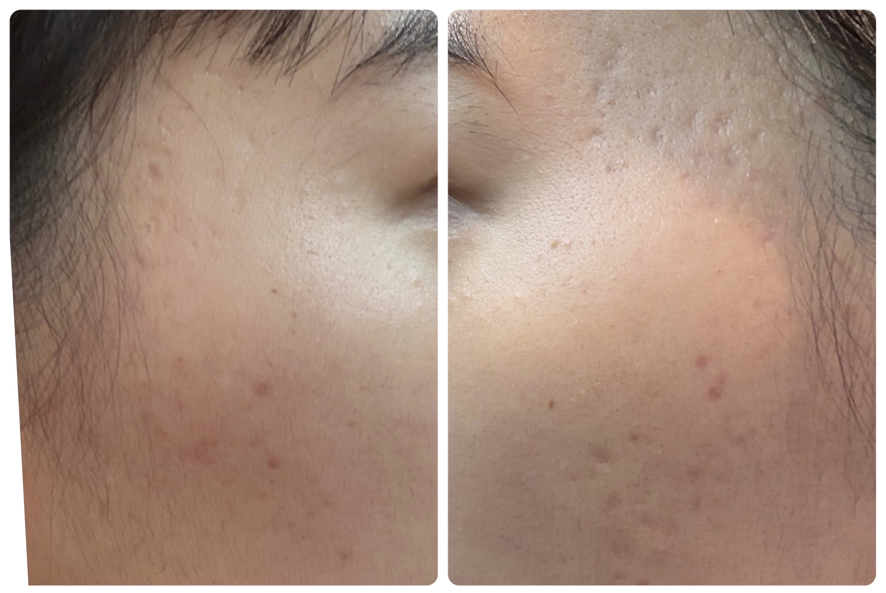 AGE-R ブースタープロ ホワイト（ミニ）/MEDICUBE/美顔器・マッサージを使ったクチコミ（2枚目）