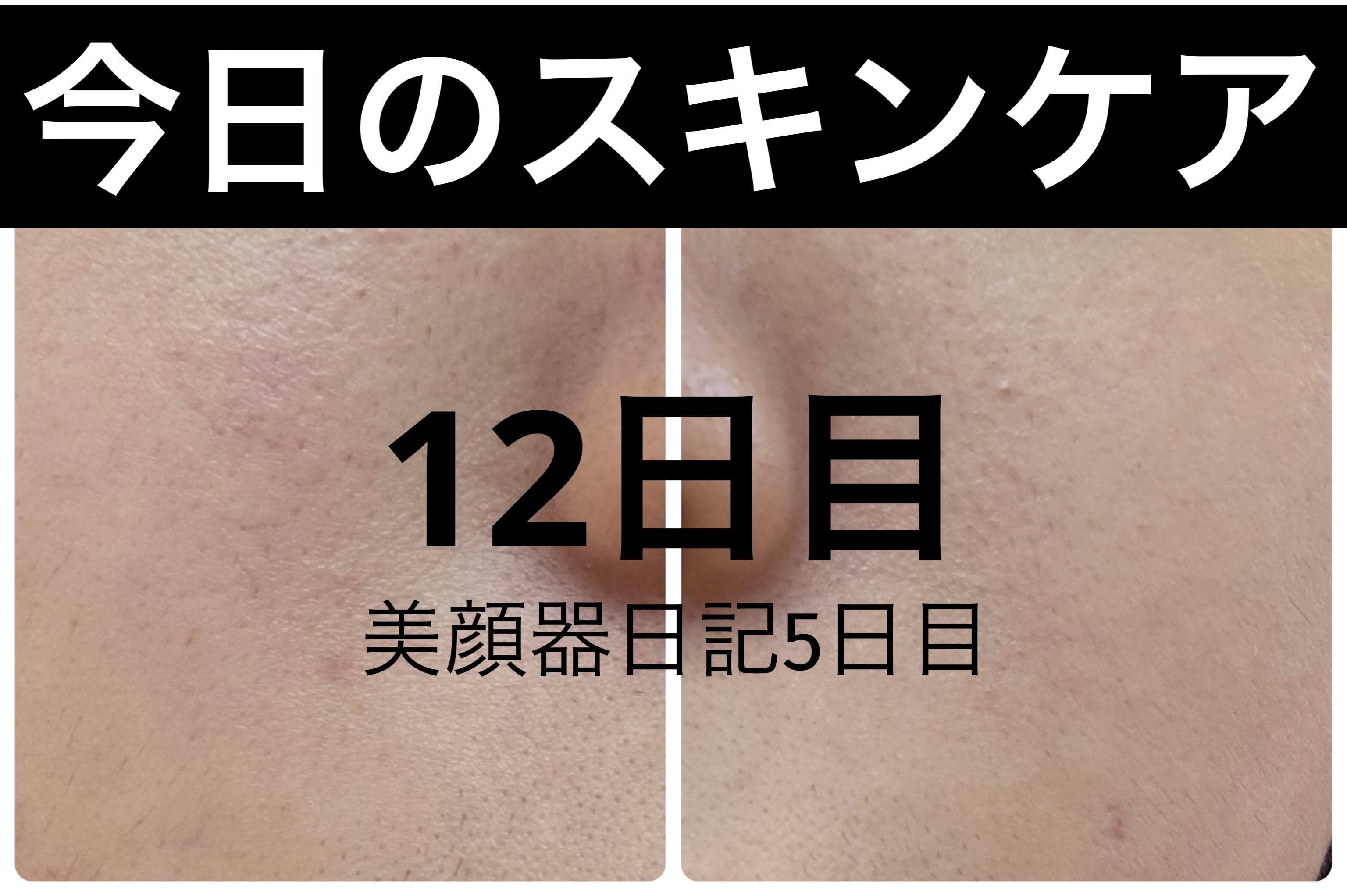 AGE-R ブースタープロ ホワイト（ミニ）/MEDICUBE/美顔器・マッサージを使ったクチコミ（1枚目）