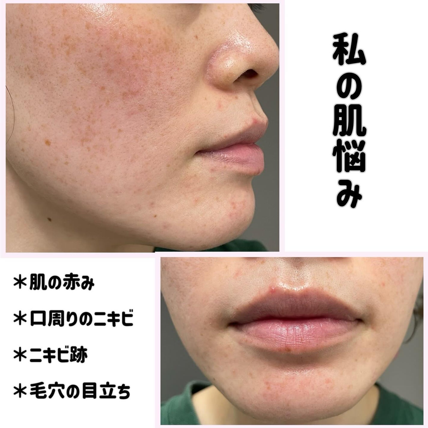 ダーマジェンシー ゼロカ81 クリーム/DERMAGENCY/フェイスクリームを使ったクチコミ(4枚目)