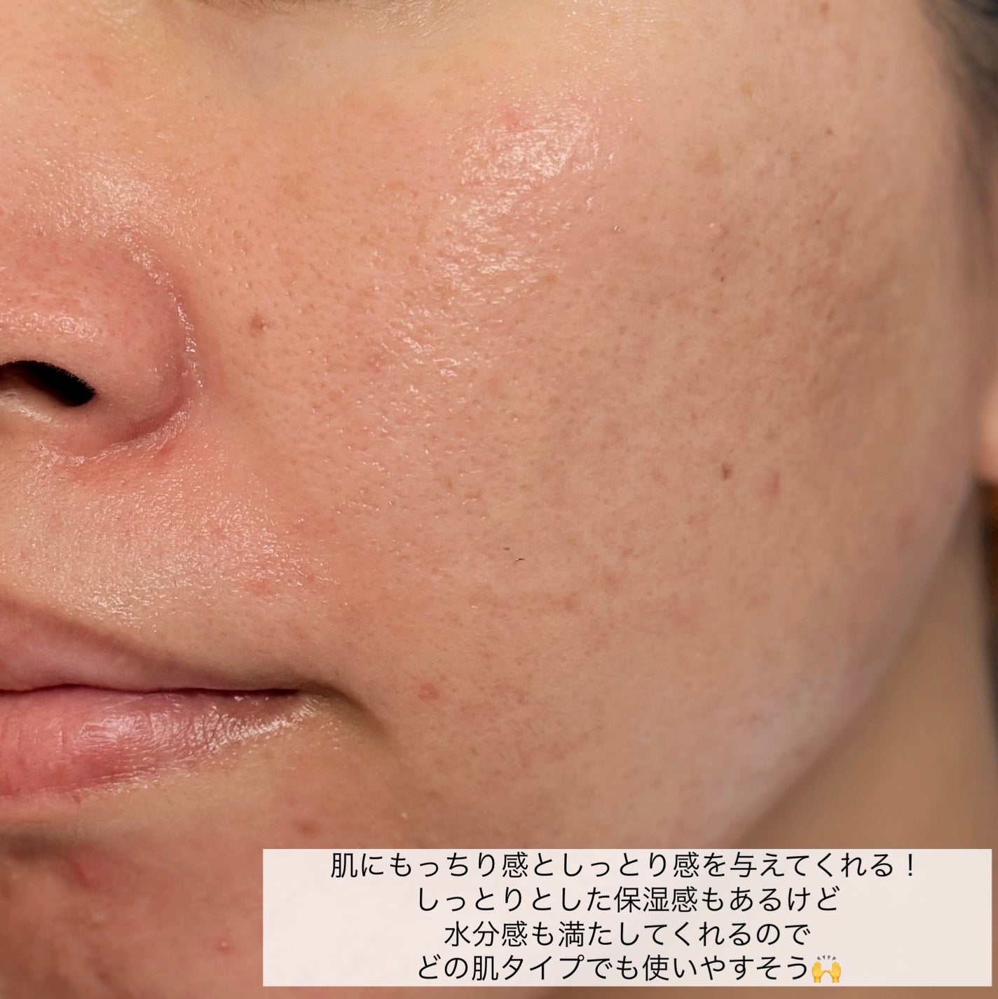 ダーマジェンシー ゼロカ81 クリーム/DERMAGENCY/フェイスクリームを使ったクチコミ(6枚目)