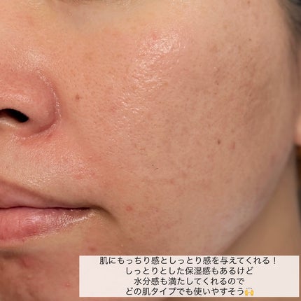 ダーマジェンシー ゼロカ81 クリーム/DERMAGENCY/フェイスクリームを使ったクチコミ(6枚目)