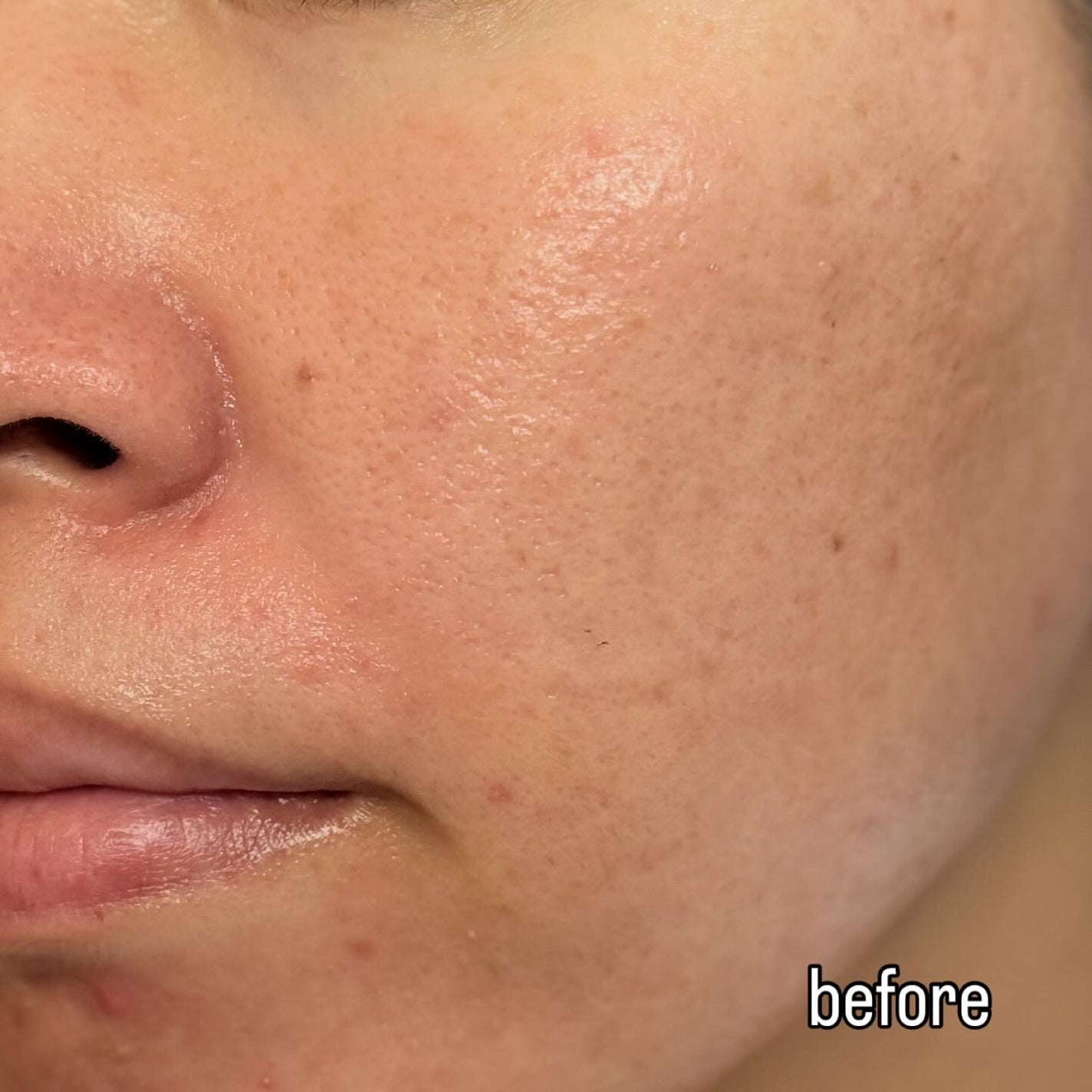 ダーマジェンシー ゼロカ81 クリーム/DERMAGENCY/フェイスクリームを使ったクチコミ(7枚目)