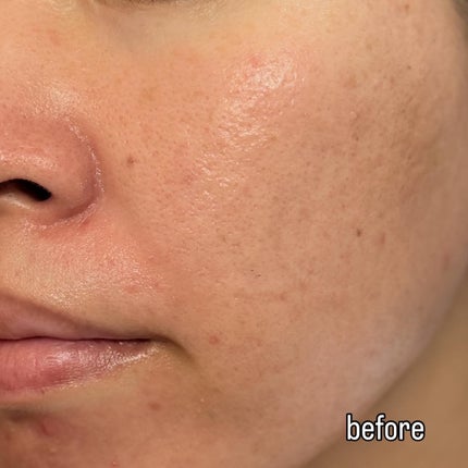 ダーマジェンシー ゼロカ81 クリーム/DERMAGENCY/フェイスクリームを使ったクチコミ(7枚目)