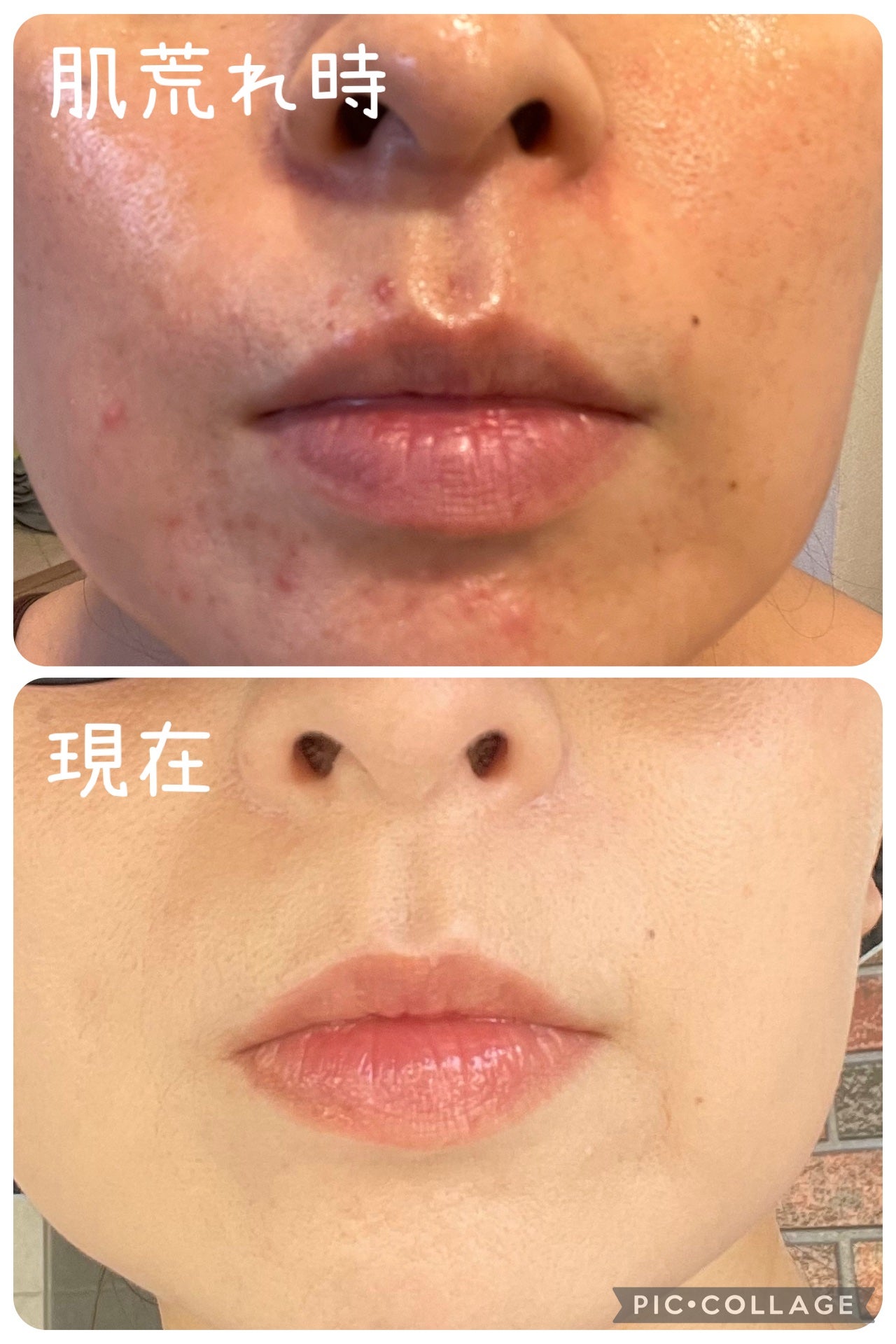 十味敗毒湯エキス錠クラシエ(医薬品)/クラシエ薬品/その他を使ったクチコミ(2枚目)