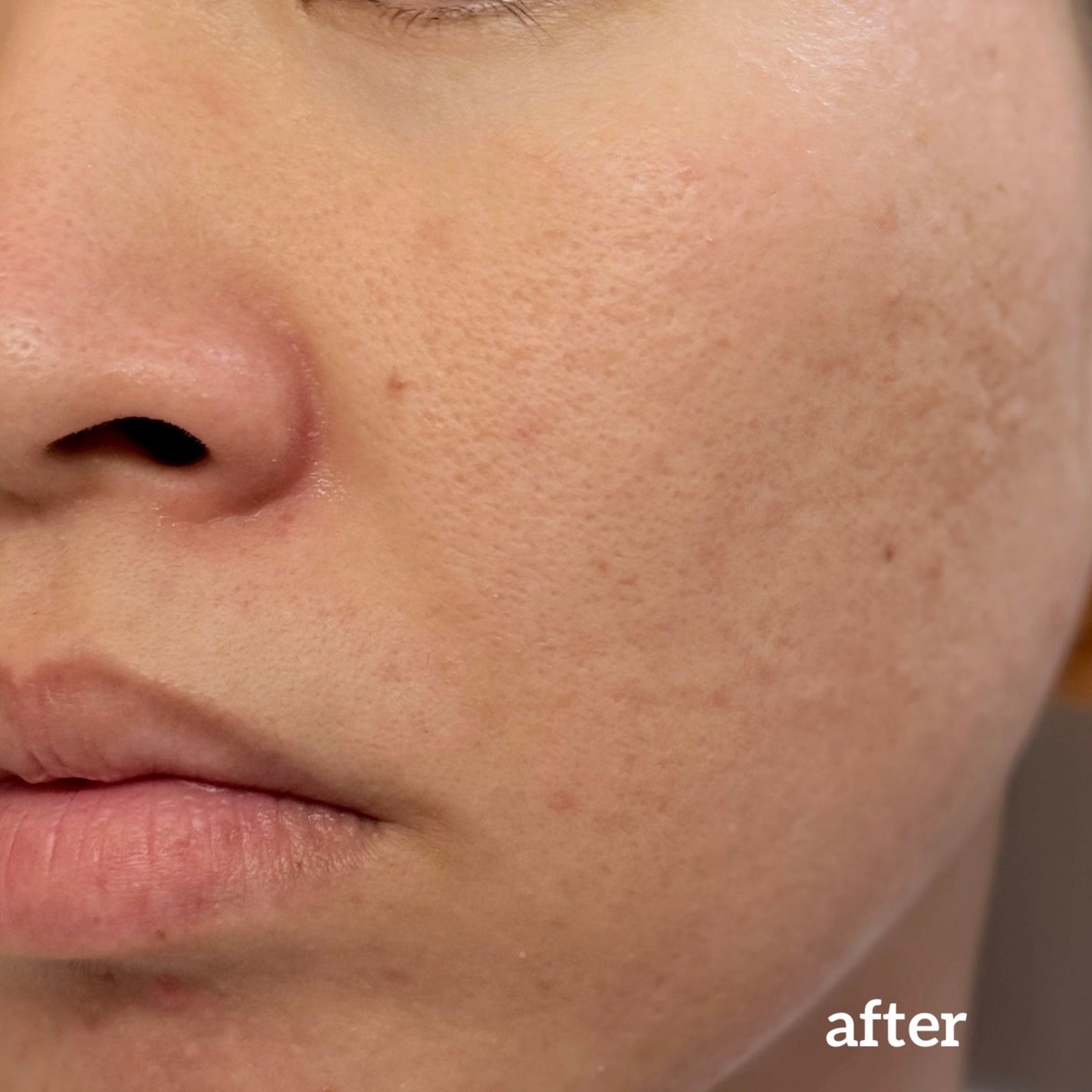 ダーマジェンシー ゼロカ81 クリーム/DERMAGENCY/フェイスクリームを使ったクチコミ(8枚目)