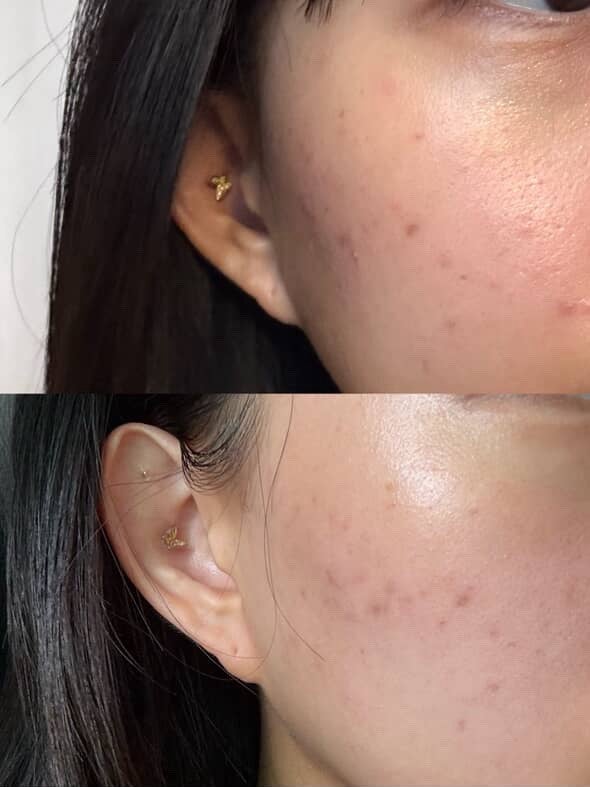 リデンス チェリートーン&スポットコレクターアンプル/redence/美容液を使ったクチコミ(2枚目)