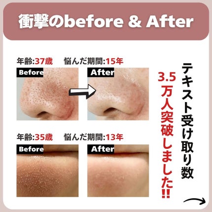 あなたの肌に合ったスキンケア💐コーくん先生 on LIPS 「🎁残り13名限定🎁こんな人は毛穴の開き一生消えない🥲..あなた..」(7枚目)