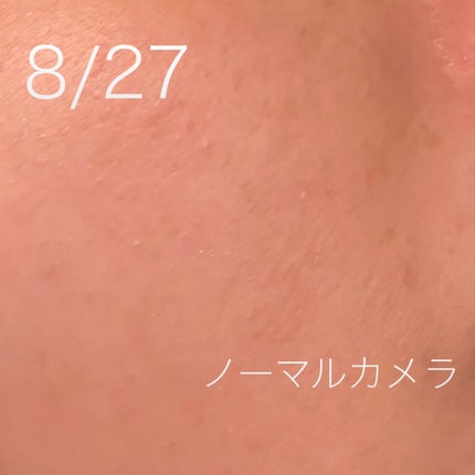 kaori on LIPS ãð¿â¬6æ¥éã®å¹æã¯ïŒïŒð¿â¬â«ïžDERMAGENCYããŒããžã§ã³..ãïŒ4æç®ïŒ