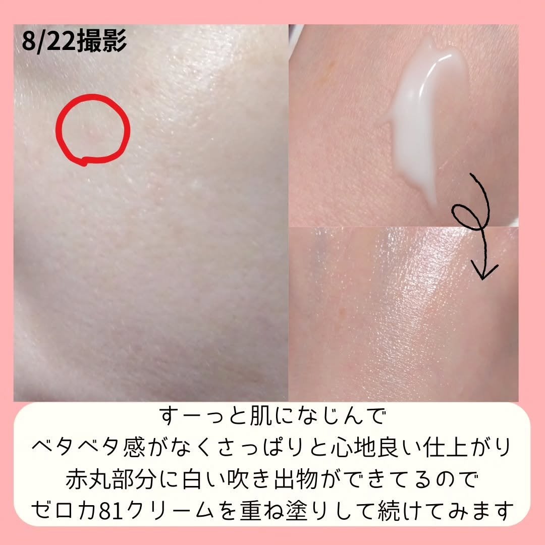 ダーマジェンシー ゼロカ81 クリーム/DERMAGENCY/フェイスクリームを使ったクチコミ(3枚目)