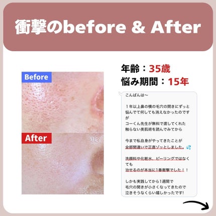 あなたの肌に合ったスキンケア💐コーくん先生 on LIPS 「【これガチで効果ヤバい】角栓エグい消える洗顔料3選🎁..あなた..」(3枚目)