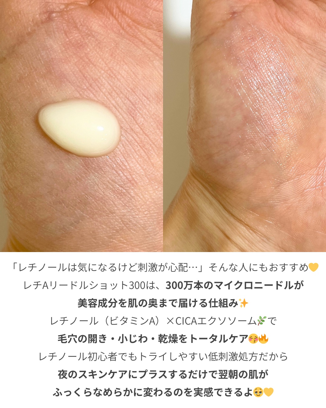 レチA リードルショット300/VT/美容液を使ったクチコミ（2枚目）