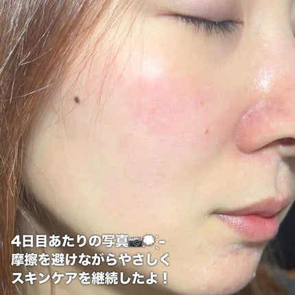 ボタニカルピーリングパウダー&ベースジェルLevel1/BOTANICAL PEEL/ピーリングを使ったクチコミ(6枚目)