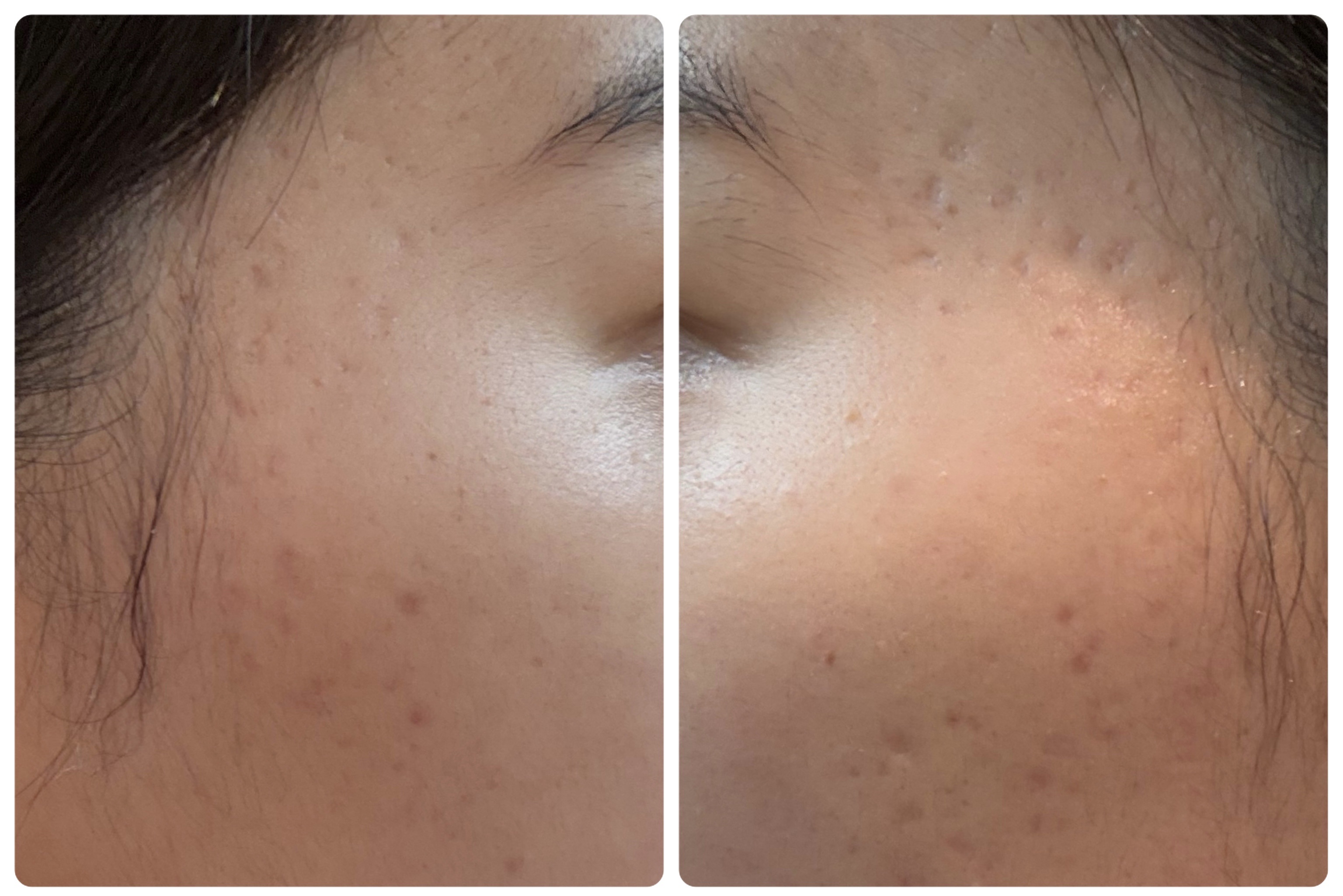 PDRNピンクアンプル PDRN 10,000ppm配合/MEDICUBE/美容液を使ったクチコミ（2枚目）