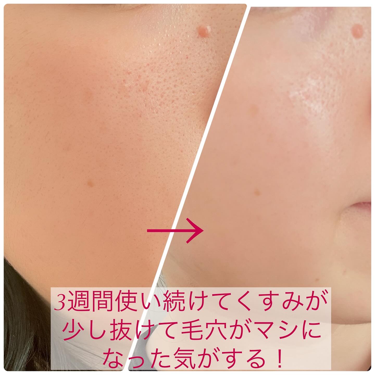 アルブチン スキンブースター セラム/MEDITHERAPY/美容液を使ったクチコミ（3枚目）