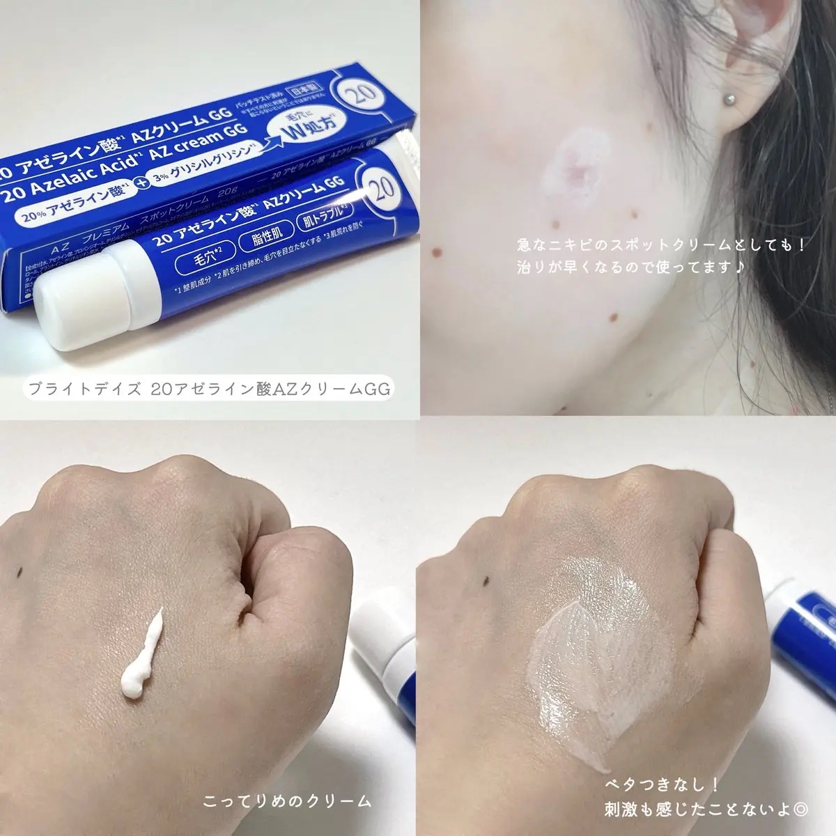 20 アゼライン酸AZクリームGG/ブライトデイズ/フェイスクリームを使ったクチコミ（2枚目）