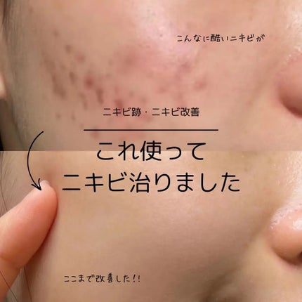 アネトス アクネケア トリートメント セラム/Anetos/美容液を使ったクチコミ(1枚目)