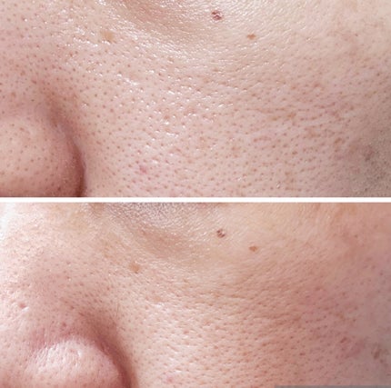 C×AZ ダーマインショット200/ESIENCE/美容液を使ったクチコミ(5枚目)