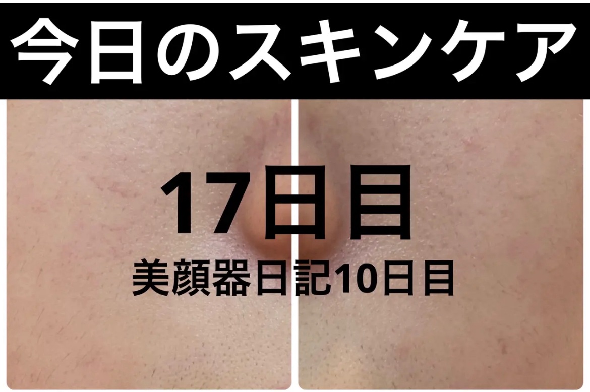 AGE-R ブースタープロ/MEDICUBE/美顔器・マッサージを使ったクチコミ（1枚目）