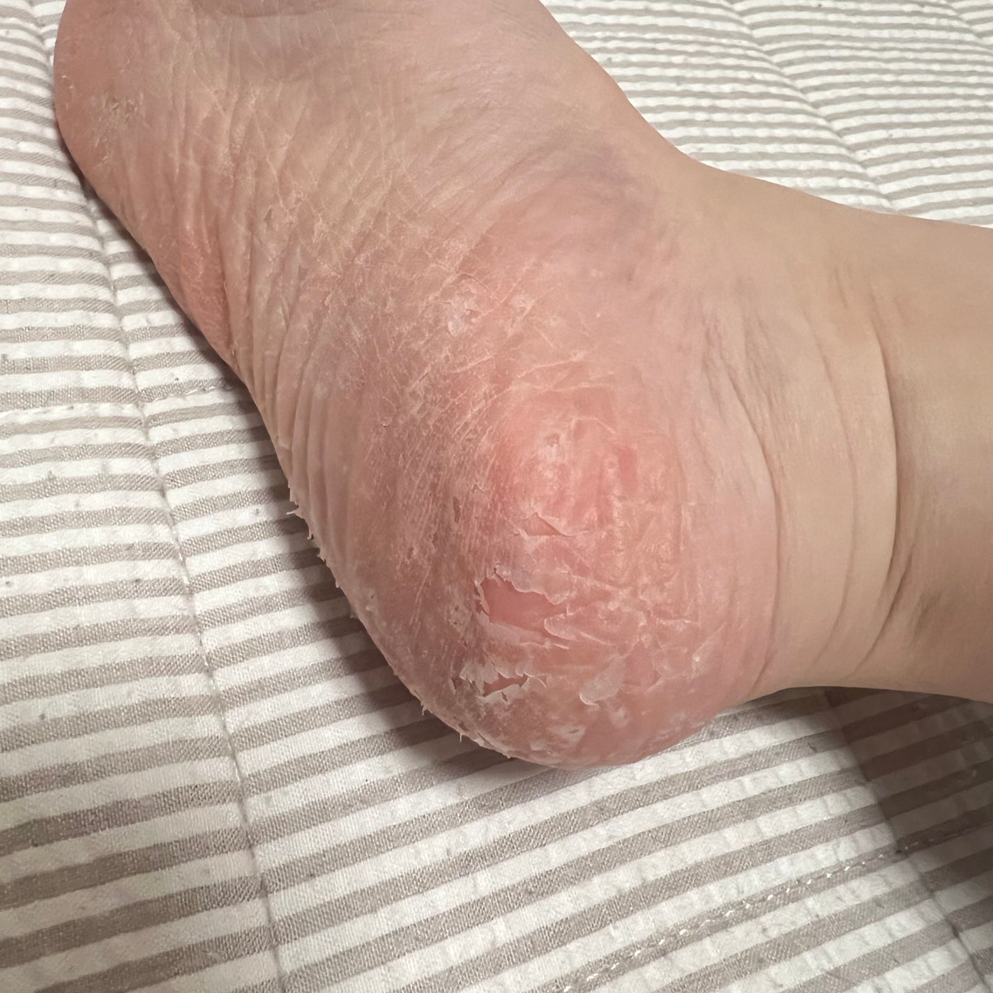 イージーパックDP60分タイプ/ベビーフット/レッグ・フットケアを使ったクチコミ(6枚目)