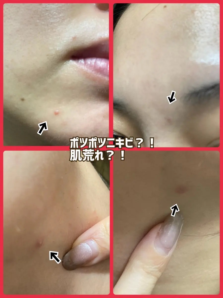 SOSスポットクリアクリーム/One-day&#39;s you/フェイスクリームを使ったクチコミ（3枚目）