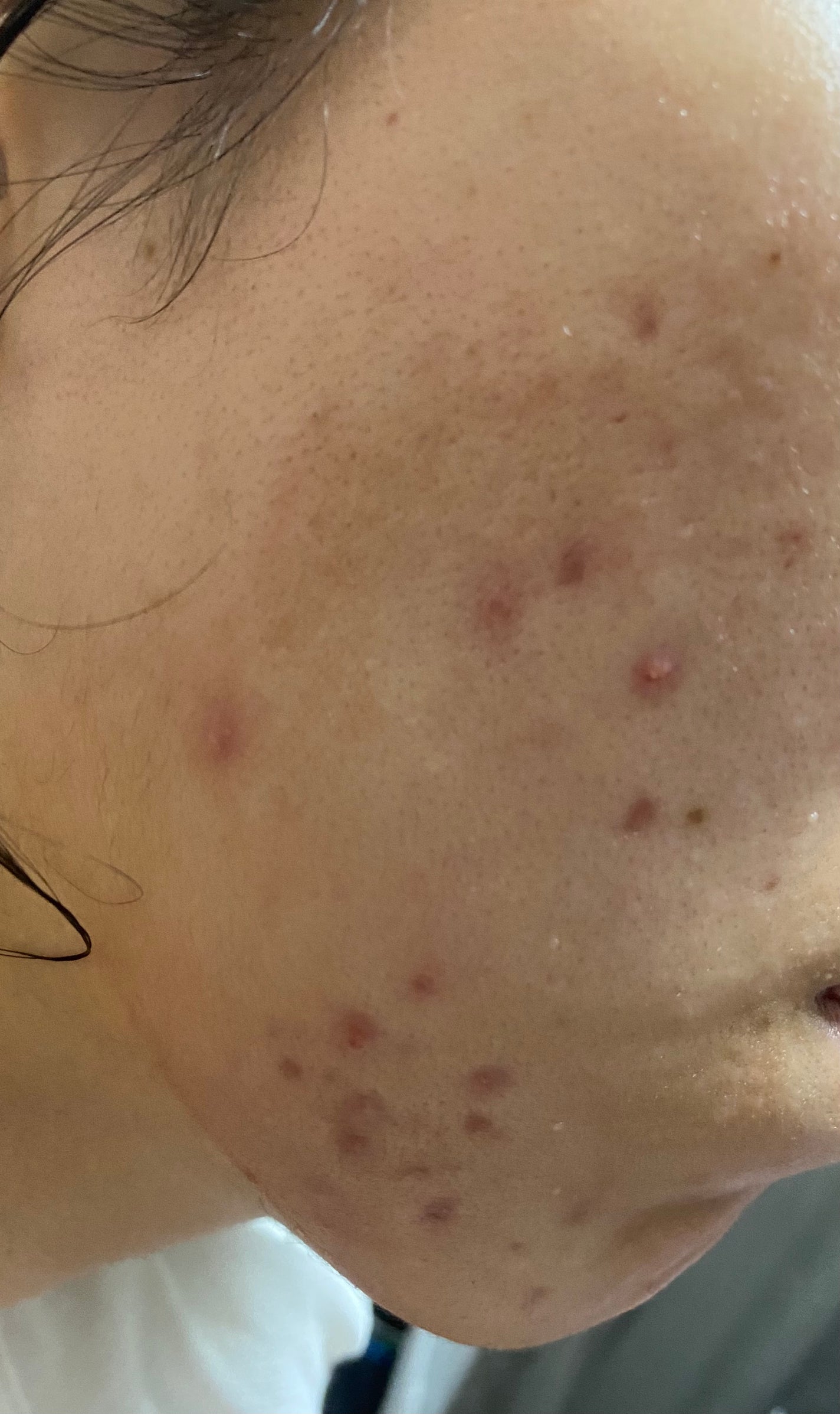 ゆうり on LIPS 「※写真閲覧注意2枚目以降ニキビの肌荒れ写真です。2025.09..」(2枚目)