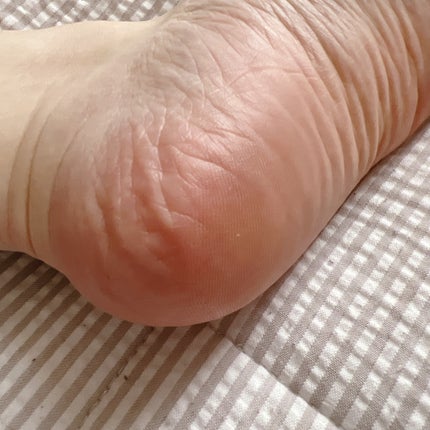 イージーパックDP60分タイプ/ベビーフット/レッグ・フットケアを使ったクチコミ(5枚目)