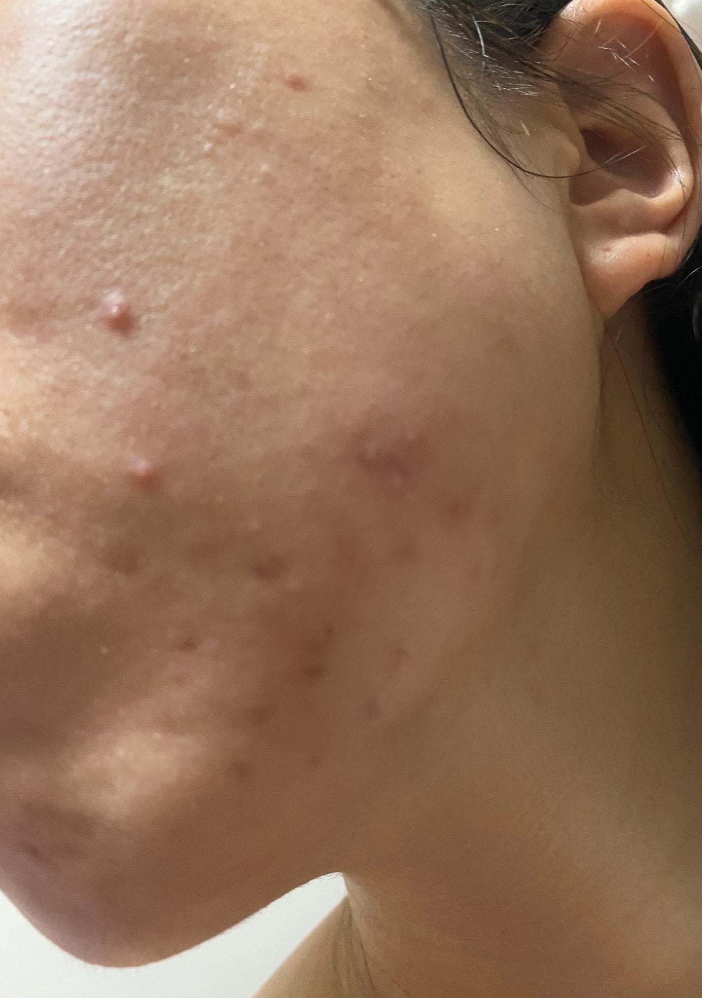 ゆうり on LIPS 「※写真閲覧注意2枚目以降ニキビの肌荒れ写真です。2025.09..」(3枚目)