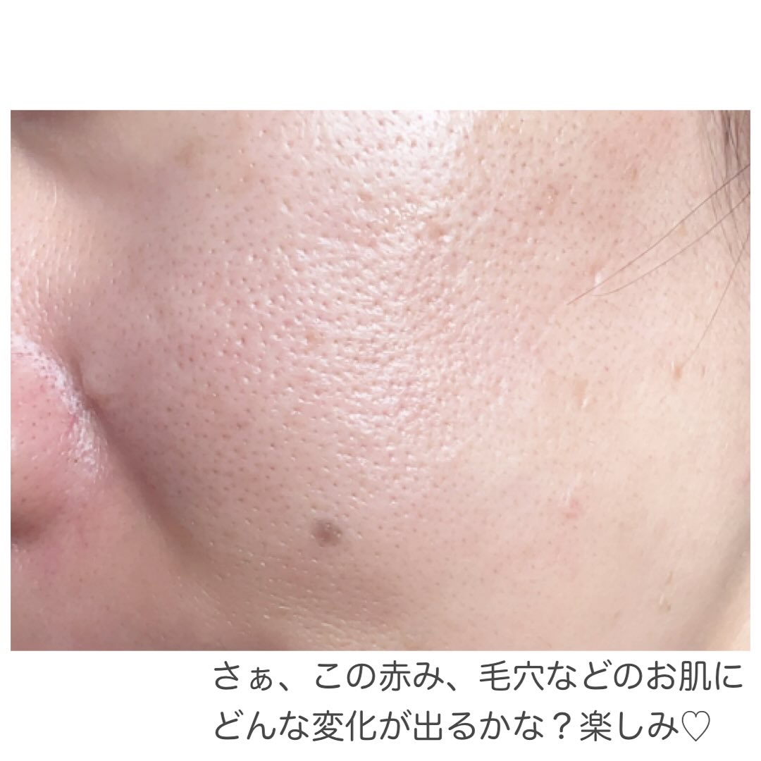 ダーマジェンシー ゼロカ81 クリーム/DERMAGENCY/フェイスクリームを使ったクチコミ（3枚目）