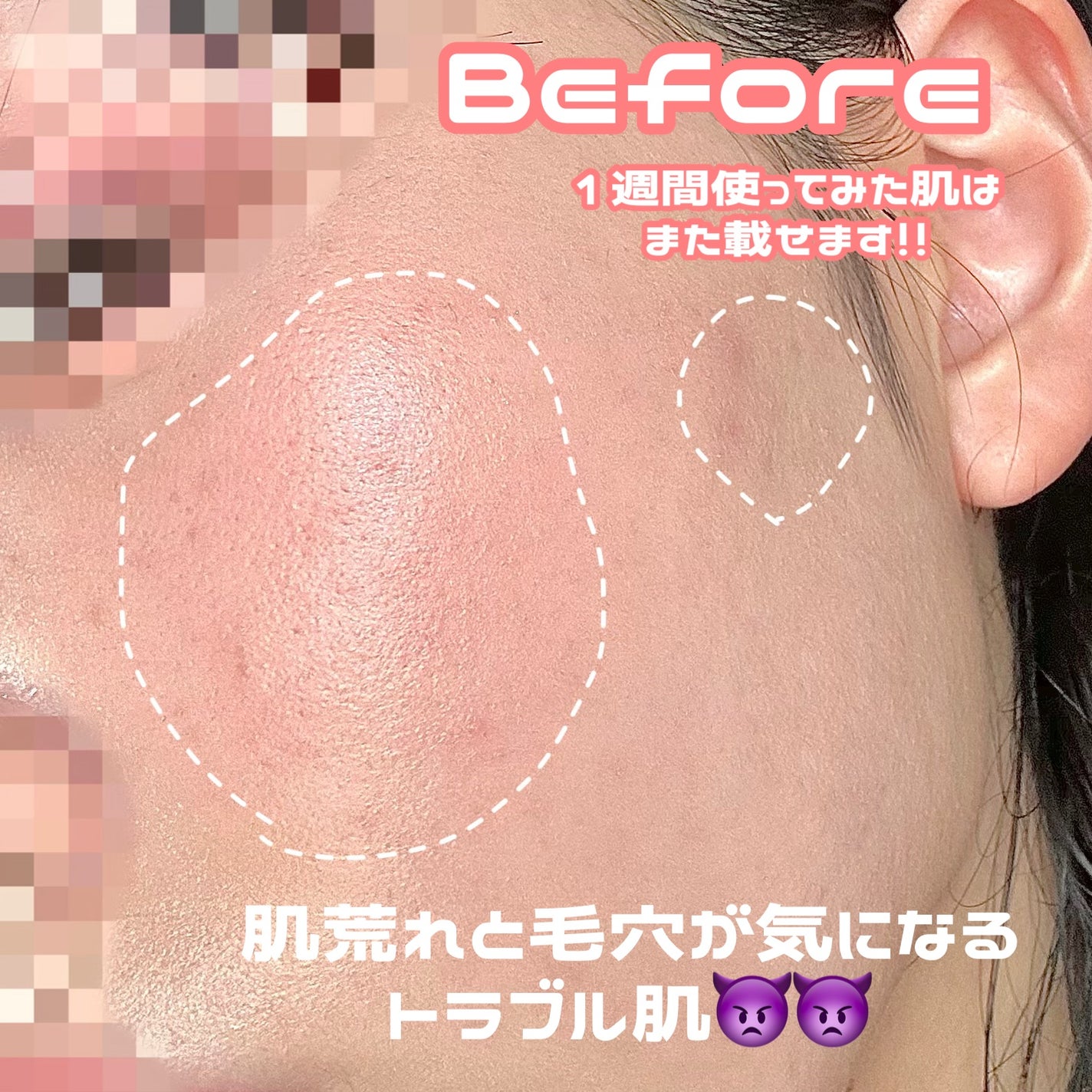ダーマジェンシー ゼロカ81 クリーム/DERMAGENCY/フェイスクリームを使ったクチコミ(3枚目)